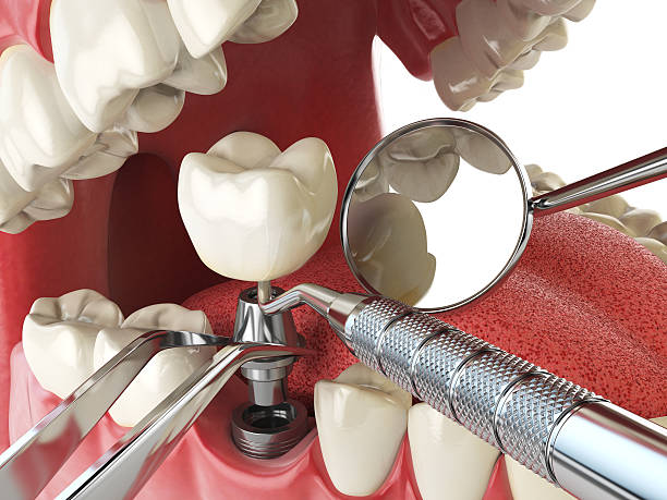 Best Emergency Root Canal Therapy in Detroit, MI